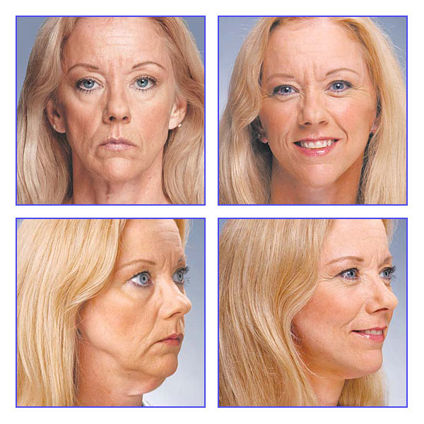 Brow Lift in Dubai 